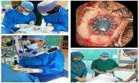 انجام سی و دومین مورد عمل جراحی پیوند قرنیه در سبزوار
