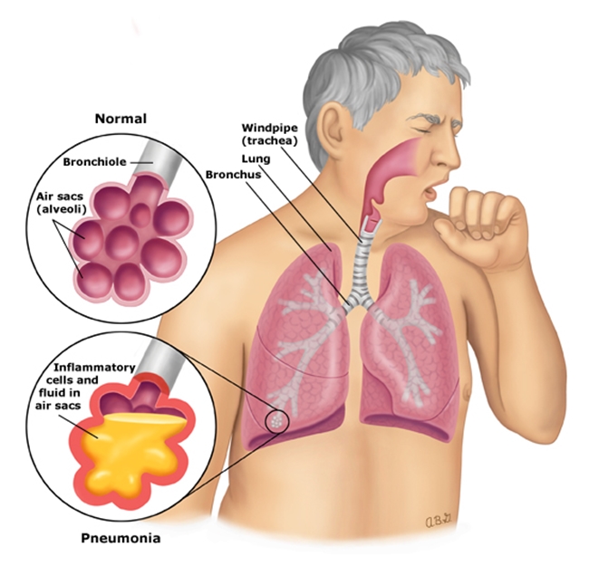 Pneumonia_anatomy_PI.jpg 