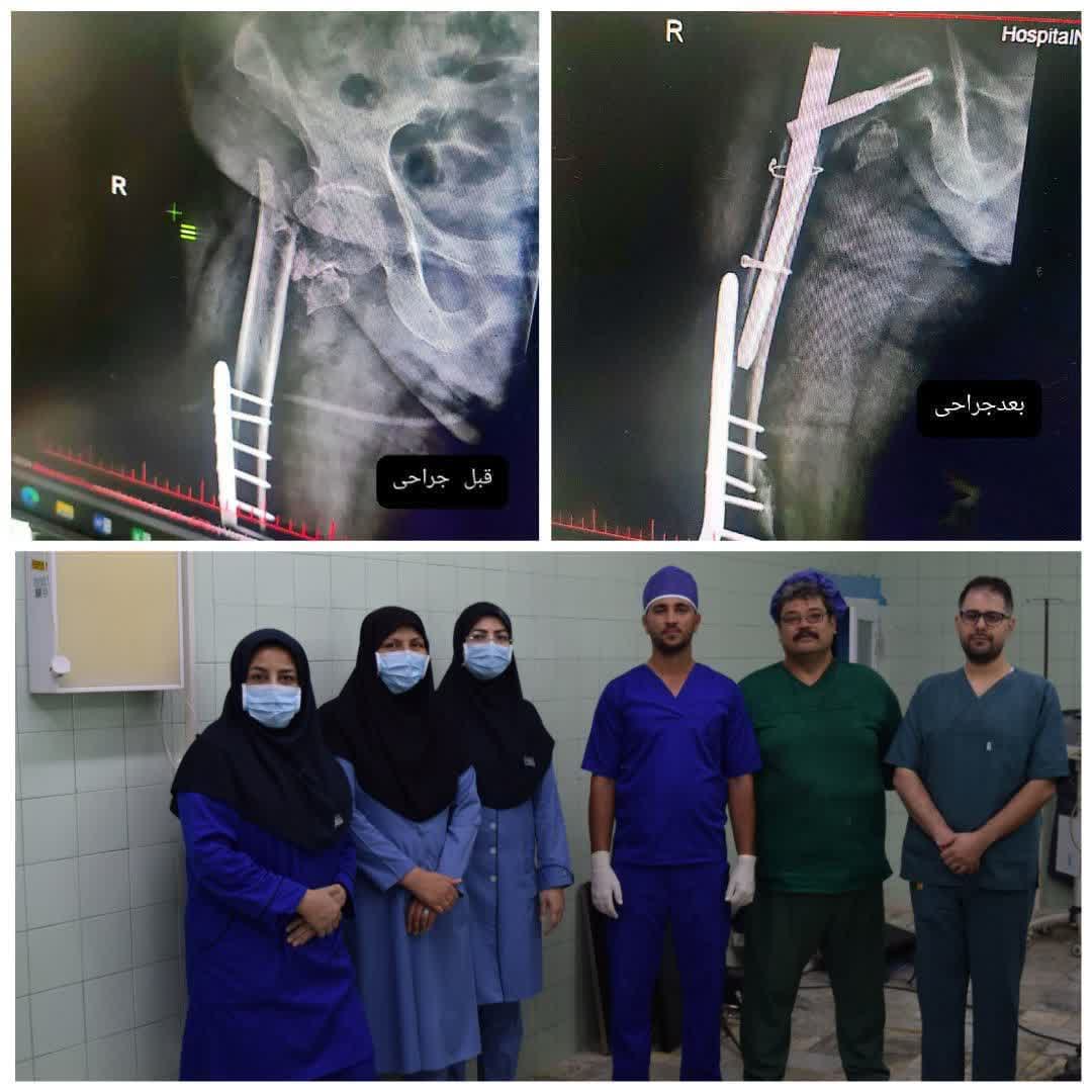 انجام موفقیت آمیز نخستین عمل جراحی PFN در بیمارستان قمربنی هاشم(ع) جوین